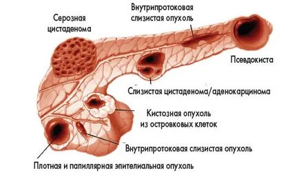 Cysta a gyomor tünetek és jelek (gyomor) Ciszta a gyomor tünetek és jelek