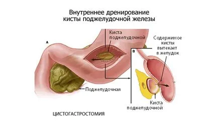 Cyst gyomornedvvel töltött hólyagszerű (töltött) Cysta a gyomor buborék folyadékkal töltött