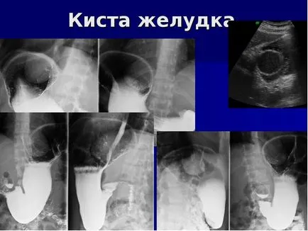 Cisztafolyadékban töltött hólyagszerű gyomor (gyomor) Cysta a gyomor buborék folyadékkal töltött