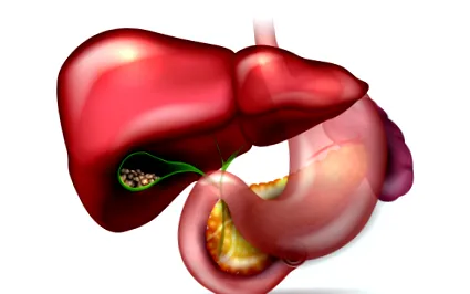 lithiasis