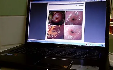 Kolposzkópia nőgyógyászati ​​mikor kell csinálni, hogyan kell felkészülni