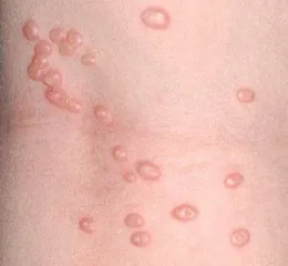 Molluscum contagiosum tünetek, fotó, kezelés, okai