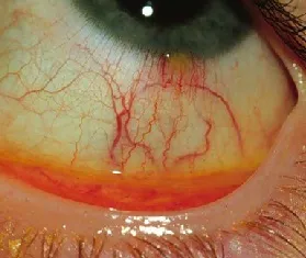 Kötőhártya-fotó, tünetei és kezelése, cseppek