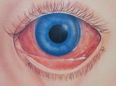 Red Eye fehérjék okait, hatásait és kezelések (kezelések) Red Eye fehérjék okait, hatásait és kezelések