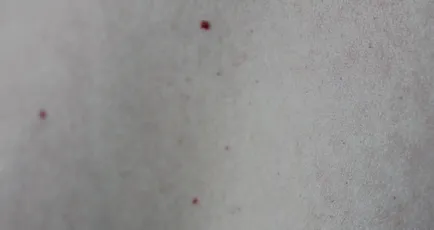 Vörös mól a test fotó, okok, kezelés, bőrbetegségek
