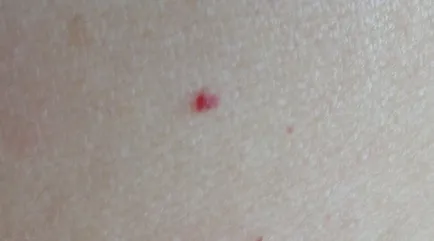 Vörös mól a test fotó, okok, kezelés, bőrbetegségek