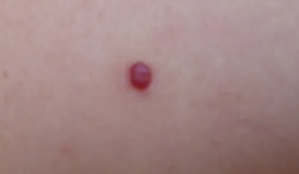 Vörös mól a test fotó, okok, kezelés, bőrbetegségek