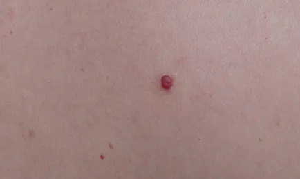 Vörös mól a test fotó, okok, kezelés, bőrbetegségek