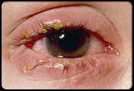 Red Eye fehérjék okait, hatásait és kezelések (piros) Red Eye fehérjék okait, hatásait és kezelések