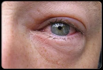 Red Eye fehérjék okait, hatásait és kezelések (kezelések) Red Eye fehérjék okait, hatásait és kezelések