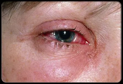 Red Eye fehérjék okait, hatásait és kezelések (szem) Red Eye fehérjék okait, hatásait és kezelések