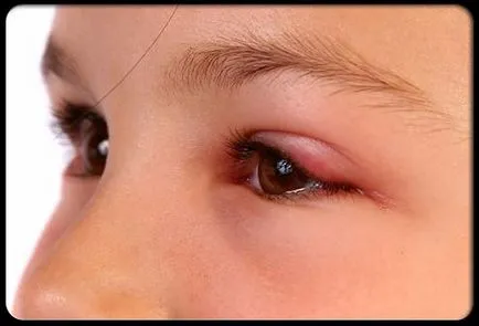 Red Eye fehérjék okait, hatásait és kezelések (szem) Red Eye fehérjék okait, hatásait és kezelések