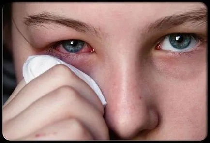 Red Eye fehérjék okait, hatásait és kezelések (kezelések) Red Eye fehérjék okait, hatásait és kezelések