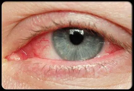 Red Eye fehérjék okait, hatásait és kezelések (kezelések) Red Eye fehérjék okait, hatásait és kezelések