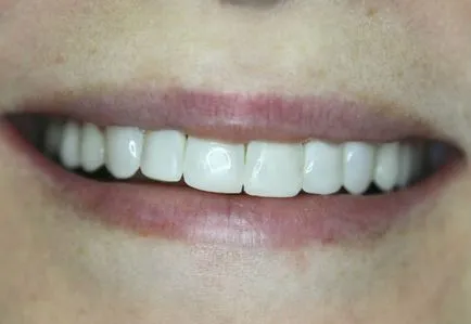 Gyönyörű fogak -, hogyan kell csinálni, és mennyibe kerül, (Startsmile ajánlja fogászat) Gyönyörű fogak -, hogyan kell csinálni, és mennyibe kerül,