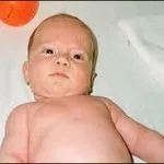 Torticollis csecsemők tünetek, okok, kezelés, masszázs, torna