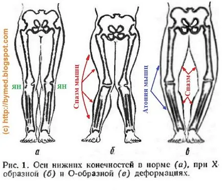Curves lábak - okai formáció, alternatív gyógyászat (jóga) Bandy lábak - az oka a formáció, az alternatív gyógyászat