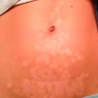 A lézeres szőrtelenítés ellenjavallatok, és egészségi következményei, kár és mellékhatások (fotó és