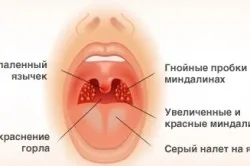 Kezelés antibiotikumokkal purulens angina (angina) A kezelés gennyes mandulagyulladás antibiotikumok