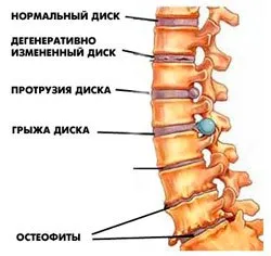 Kezelése népi jogorvoslati chondrosis