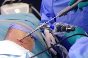 A kezelés és a lézeres műtét sérv a nyaki gerinc lemez eltávolítása és párologtatással (sérv) Kezelés és lézeres műtét sérv nyaki gerinc lemez eltávolítása és párologtatással