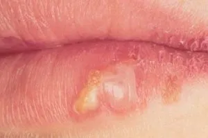 Herpes Otthon kezelése népi jogorvoslati (herpes gyorsan haza, hogy megszabaduljon ajak népi orvosság a harcot) Herpesz otthoni kezelés népi jogorvoslati