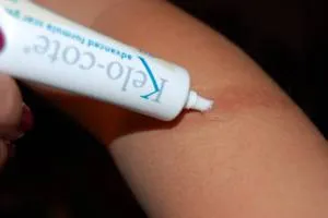 Kezelése hegesedés gél és spray kelo-Cote, utasítás és alkalmazás (hegek) Kezelése hegesedés gél és spray kelo-Cote, használati és alkalmazása