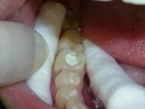 caries kezelést otthon és a fogászatban