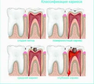 caries kezelést otthon és a fogászatban