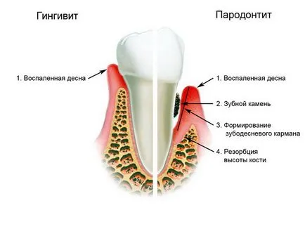 periodontitis kezelése népi jogorvoslat leghatékonyabb módja (a legtöbb) periodontitis kezelése népi jogorvoslat leghatékonyabb módja