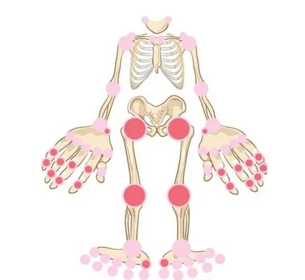 A kezelés sokízületi gyulladás népi jogorvoslati az otthoni (polyarthritis) arthritis kezelése népi jogorvoslati otthon