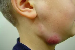 A nyirokcsomók a fej és a nyak egy férfi és egy gyermek elrendezés és fotók