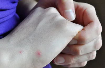Burst erek a kéz és az ujjak, miért, mit kell csinálni, és hogyan kell eltávolítani