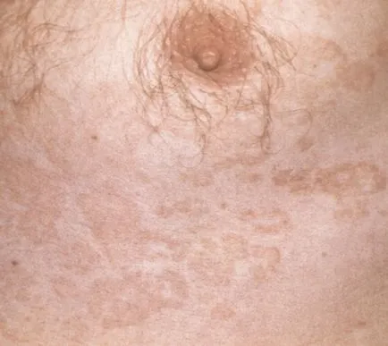 Pityriasis versicolor - egy