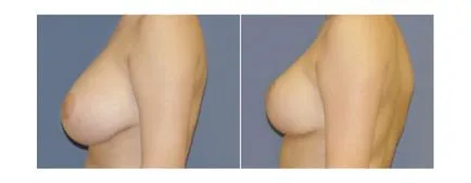 Reduction mammoplasty - mi ez, és milyen esetekben szükséges (Reduction) Reduction mammoplasty - mi ez, és milyen esetekben szükséges