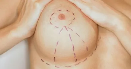 Reduction mammoplasty - mi ez, és milyen esetekben szükséges (mammoplasty) Reduction mammoplasty - mi ez, és milyen esetekben szükséges