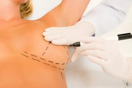 Reduction mammoplasty - mi ez, és milyen esetekben szükséges (bármilyen) Reduction mammoplasty - mi ez, és milyen esetekben szükséges
