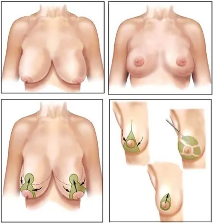 Reduction mammoplasty - mi ez, és milyen esetekben van szükség (a mell megnagyobbodása) Reduction mammoplasty - mi ez, és milyen esetekben szükséges