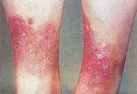 Mikrobiológiai ekcéma - okai, tünetei, diagnózisa és kezelése