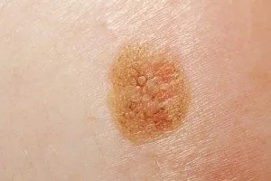 melanoma a bőr fotó és a kezdeti szakaszban, prognózis