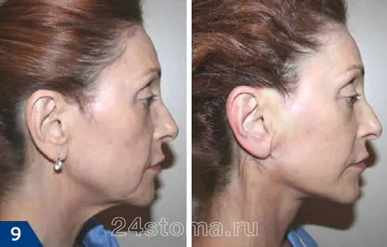 Mezoniti - vélemények, fotók előtt és után a face-lift, a negatív hatásokat