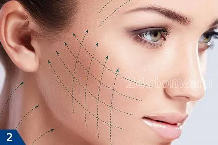 Mezoniti - vélemények, fotók előtt és után a face-lift, a negatív hatásokat