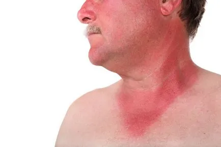 Egér láz tünetei férfiaknál, szövődmények (rat) Egér láz tünetei férfiaknál, szövődmények
