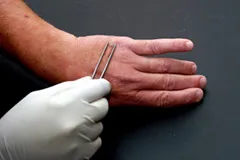 Lehet vágni a szemölcsök a test egyedül