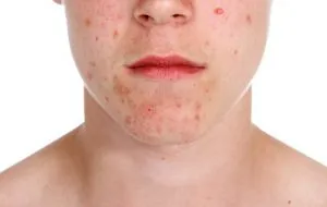 Folk jogorvoslati hyperpigmentation receptek, ellenjavallatok, megelőzés
