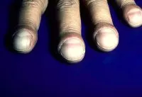 Nails - óraüvegekkel - az oka a tünet