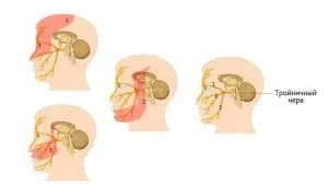Neuralgia arcideg tünetek és a kezelés