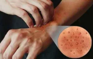 Atópiás dermatitis tünetei és kezelése