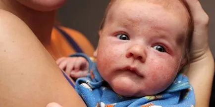 Az atópiás dermatitis - az okokat felnőttek és gyermekek, a fotó (előfordulás) Az atópiás dermatitis - az oka a gyermekek és felnőttek, fotók