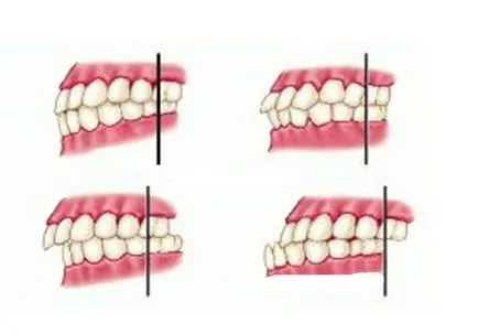 Malocclusion a gyermek 7 éves